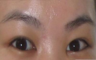 近视眼全飞秒手术后可以游泳么(飞秒近视眼手术后视力会下降)