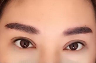 做完双眼皮下眼皮肿是什么情况(做完双眼皮下眼皮肿是什么情况)
