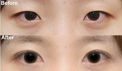 眼皮下垂怎么按摩眼睛(眼皮松弛下垂怎么按摩恢复)