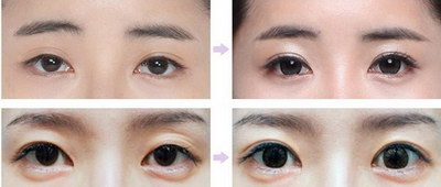 上眼皮脂肪厚的办_眼睛上眼皮脂肪厚怎么去除