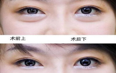 做全切双眼皮的线多久可以吸收【全切双眼皮多久可以涂眼影】