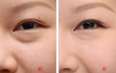 激光洗眼线结痂几天脱落(激光洗眼线几天结痂变淡)