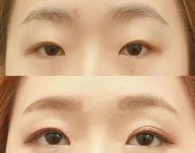 割双眼皮拆线之后需要抹药吗(割双眼皮之后几天拆线)