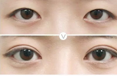 15岁眼睛散光怎么办才能恢复
