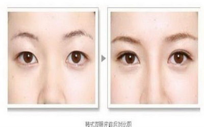 眼睛红肿也可以用热敷来加快痊愈(眼睛红肿怎么办？)