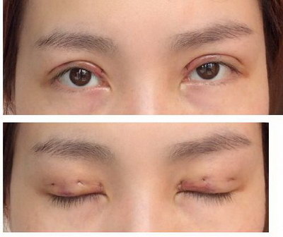 眼角发红怎么治疗(眼角发红痒是怎么回事怎么治疗)