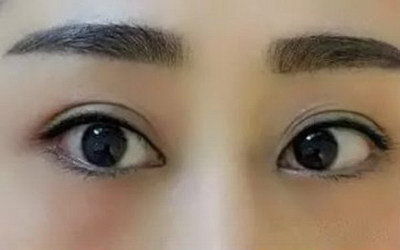 眼部刮痧对眼袋有缓解吗(脂肪型眼袋经常眼部刮痧去除掉吗)