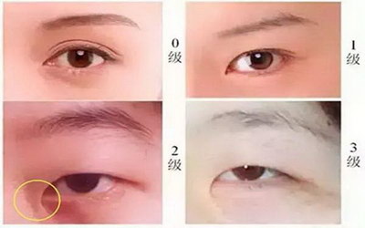 眼角出血是什么病的征兆(眼角为什么容易出血)