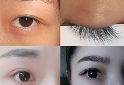 祛眼袋后吃什么恢复最快[祛眼袋什么时候恢复好]