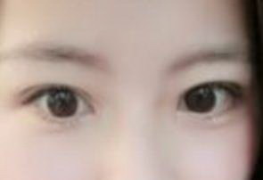 眼睛下方的皱纹做什么医美(眼睛下方的皱纹是什么)