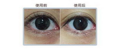 埋线双眼皮淤血怎么消(埋线双眼皮淤血怎么处理)