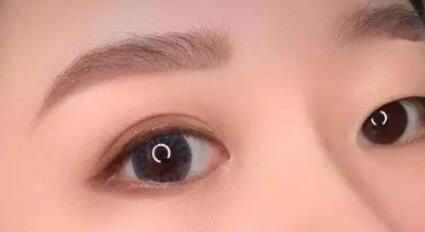 有眼袋了该怎么恢复[高度近视眼袋大怎么能恢复]