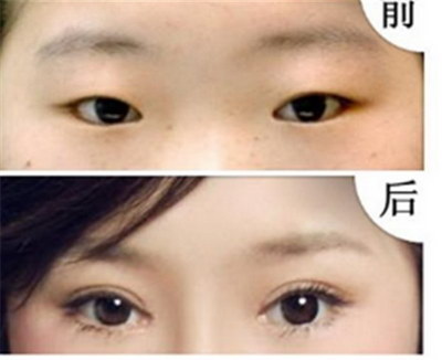 一只眼皮肿还下垂【单独一只眼睛的眼皮浮肿下垂】