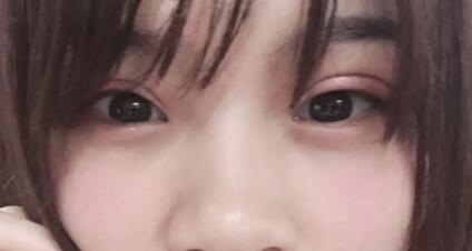怎么消除黑眼圈最有效