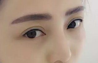 脂肪填充深眼窝有效果吗(脂肪填充眼窝多久有效)