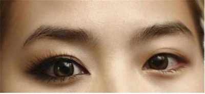 我的脸眼睛也双眼皮浮肿吃冰棍_眼睛浮肿变双眼皮