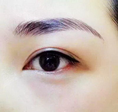 做埋线双眼皮能管多久啊？