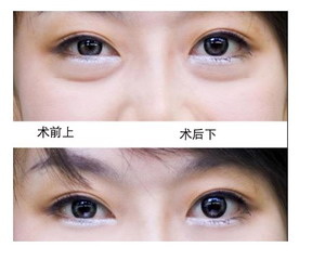 割双眼皮开眼角后眼睛特别干,都快不等睁眼了(割双眼皮开眼角后眼睛流泪是怎么了)