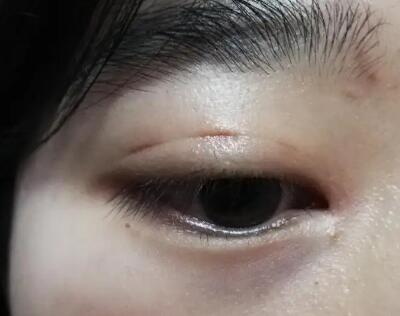 水肿眼皮怎么去除