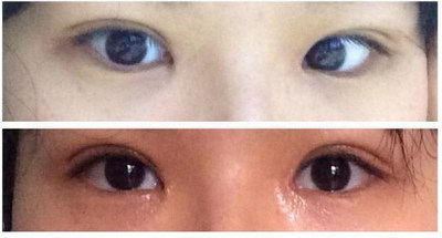 双眼皮不到24小时纱布能拆吗