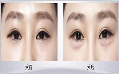 近视眼矫正术风险大吗