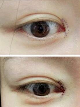 脂肪填充眼窝保持多久(使用脂肪填充眼窝的美容方法)