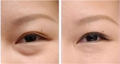 腹腔镜微创手术修补膀胱穹窿瘘(什么是膀胱穹窿瘘？)
