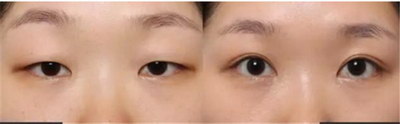 埋线双眼皮痕迹多久消失(埋线双眼皮闭眼痕迹多久消失)