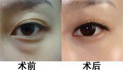 眼角可以修复吗(眼角可以修复成原来样子吗)