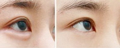 怎么袪黑眼圈眼袋(如何消除黑眼圈和眼袋)