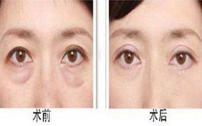 戴双眼皮贴能变成双眼皮吗(什么是双眼皮贴？)