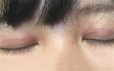 眼睛青是怎么回事