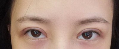单眼皮如何变成双眼皮呢