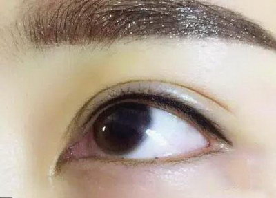 埋线双眼皮几天能出门(埋线双眼皮几天可以出门吹风)