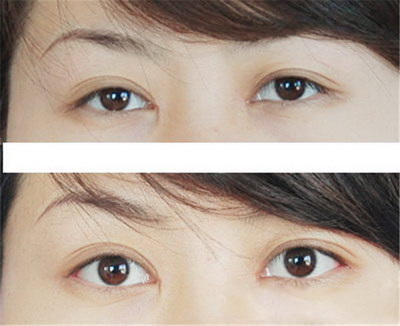 眼睛肿可以热敷吗[热敷眼睛可以去黑眼袋]