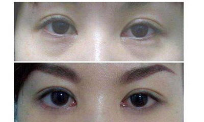 月经期间做了双眼皮好不好(月经期间做双眼皮，好还是不好？)