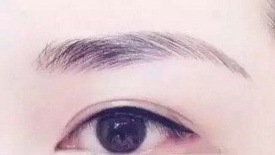 切开双眼皮术后怎么护理呢？