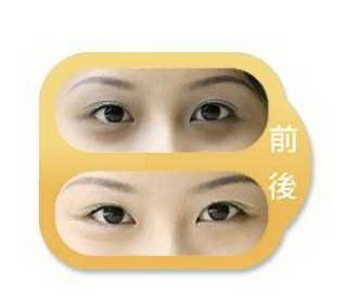 双眼皮修复哪家做好「哪家双眼皮修复做好」