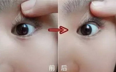 未成年应不应该做双眼皮手术呢？