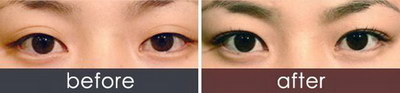 双眼皮睁眼紧绷能第三次手术吗(双眼皮睁眼紧绷，能进行第三次手术吗？)