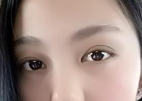 双眼皮打麻药是不是巨疼(双眼皮手术的基本情况)