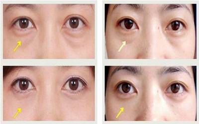 洗眼睛多少钱宜宾「眼科洗眼睛大概多少钱」