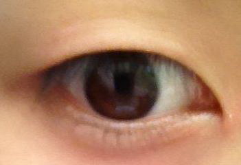 50岁女人割双眼皮可以保持几年(双眼皮手术的保持时间)