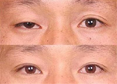 韩式切双眼皮多少钱(韩式半切双眼皮多少钱)