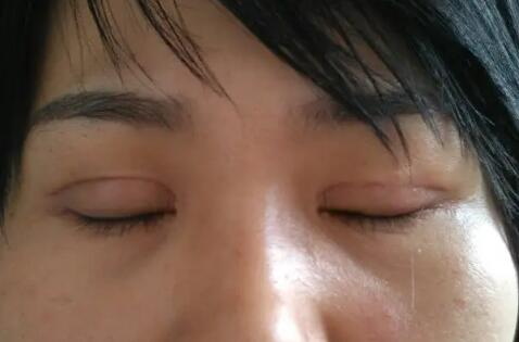 眼袋手术后能吃牛羊肉吗(眼袋手术后能否食用牛羊肉？)