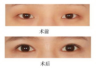 双眼皮恢复时间一般是多久(手术类型和方法影响恢复时间)