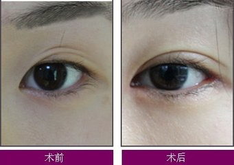 眼皮和眼袋都肿了是怎么回事(眼袋手术后眼皮松弛怎么回事)