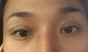 外切去眼袋手术填充泪沟危害(外切去眼袋手术能维持几年)