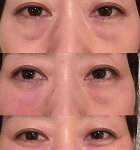 眼线纹了以后要注意些什么_哪些患者不能纹眼线