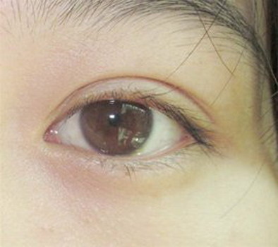 眼袋黑眼圈是什么原因造成的(眼袋黑眼圈的原因)